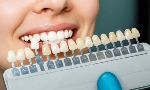 How Long Do Porcelain Veneers Last