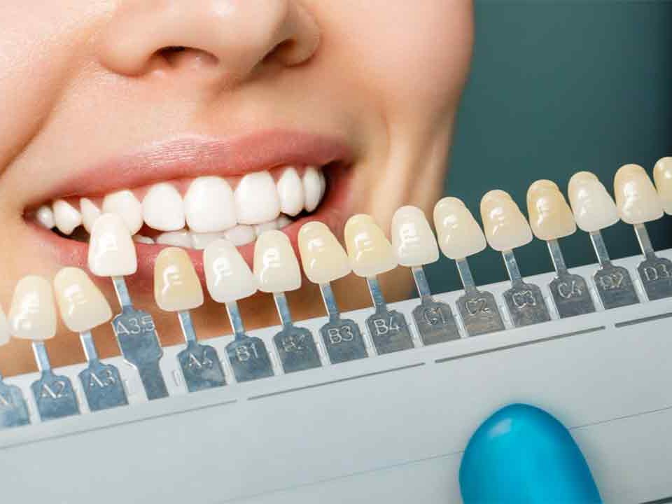 How Long Do Porcelain Veneers Last