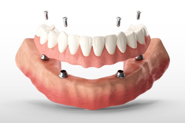All On 4 Dental Implants Phoenix AZ