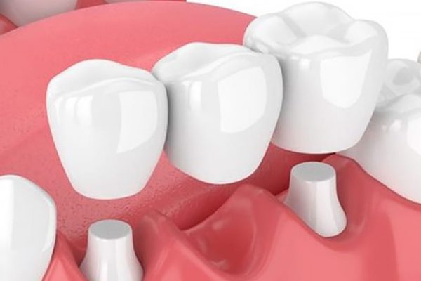 Dental Bridge in Ahwatukee, AZ
