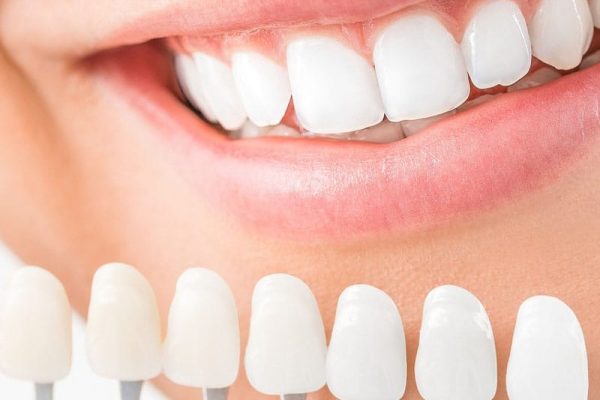 Composite Veneers in Ahwatukee, Phoenix