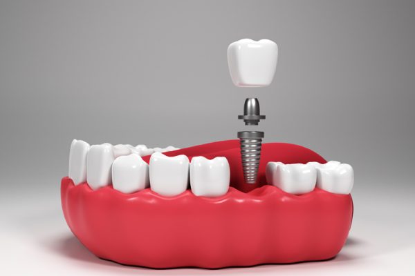 Dental Implants in Ahwatukee, Arizona