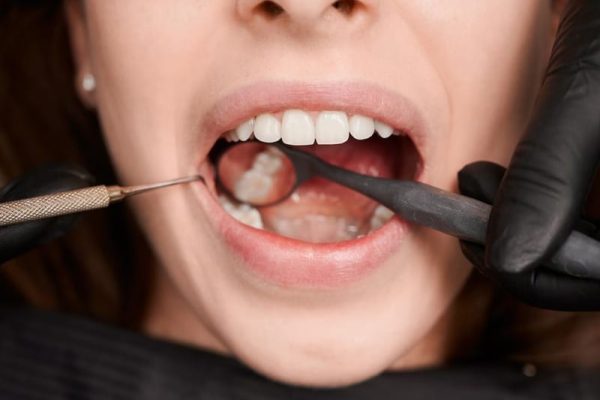 Ahwatukee Cavity Filling Dentist