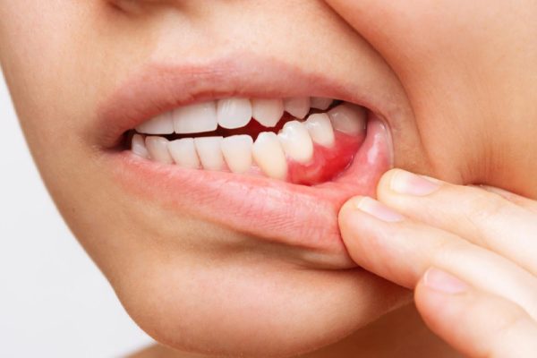 Gingivectomy in Phoenix