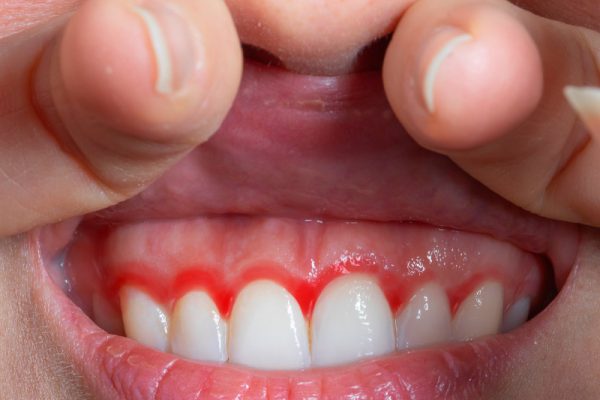 Gum Disease Treatment Phoenix