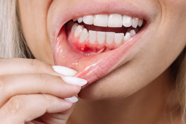 Oral Lesions in Ahwatukee, Phoenix