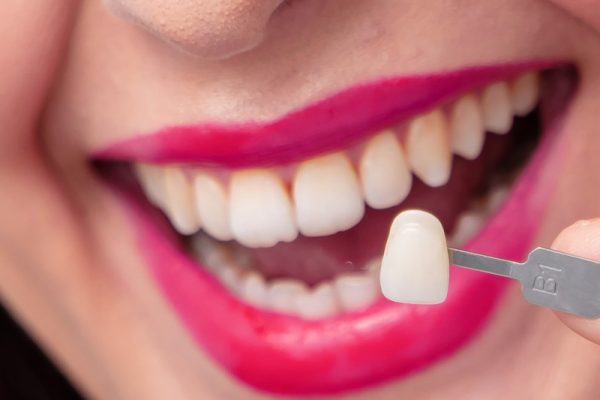 Porcelain Veneers in Ahwatukee, Phoenix