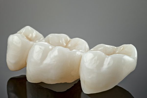 Prepless Veneers in Ahwatukee, Phoenix