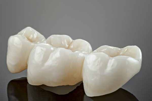 Prepless Veneers in Ahwatukee, Phoenix