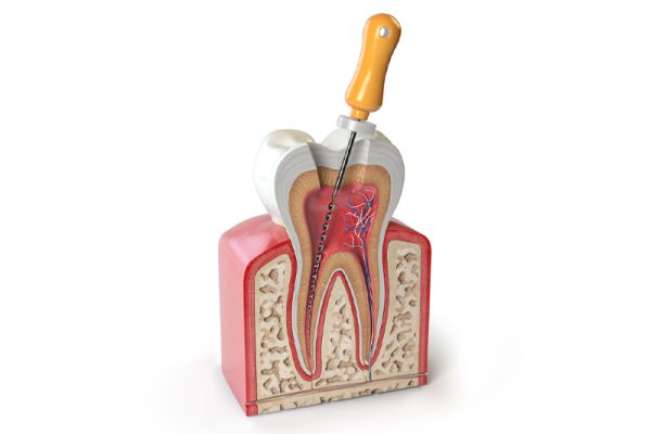 Root Canal Treatment Ahwatukee, AZ