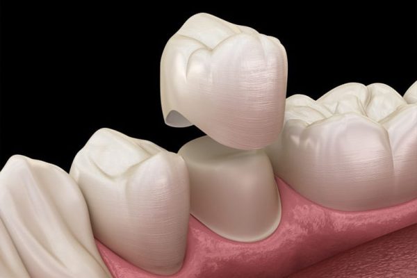 Same Day CEREC Crowns in Ahwatukee, Phoenix