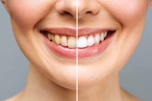 Teeth Whitening in Ahwatukee, Phoenix