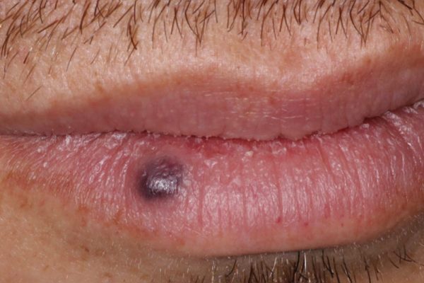 Venous Lakes Lip Treatment in Phoenix