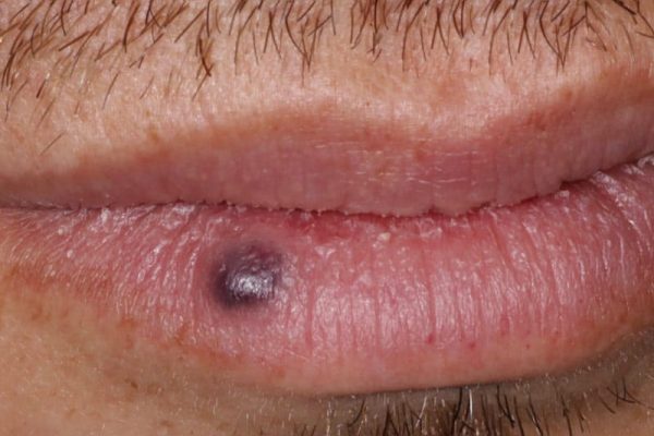 Venous Lakes Lip Treatment in Ahwatukee, Phoenix