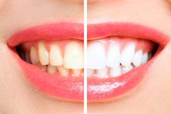 Best Teeth Whitening in Ahwatukee