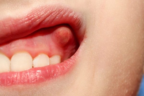 Oral Fibroma in Ahwatukee, Phoenix