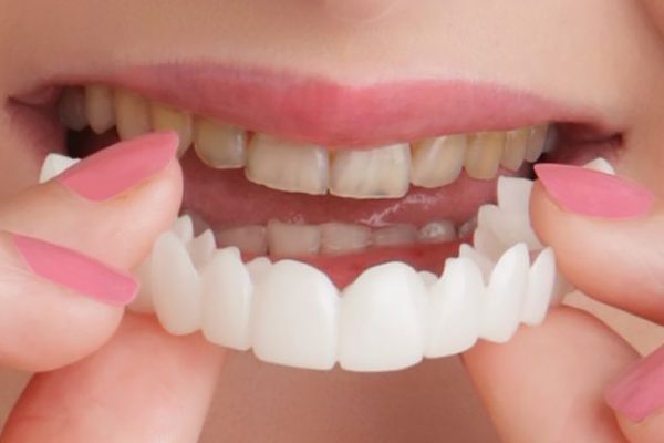 Snap-On Smile in Ahwatukee, Phoenix